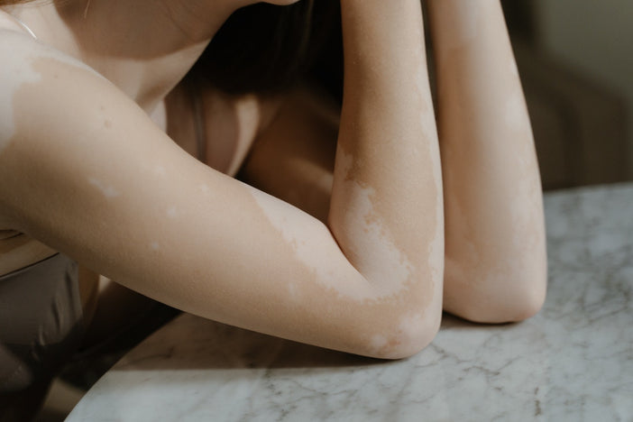 Arms of woman with vitiligo