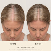 GRO+ Advanced Dermaroller Replacement Head